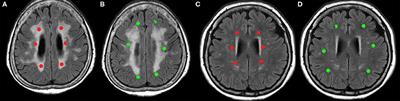 Changes in Microvascular Morphology in Subcortical Vascular Dementia: A Study of Vessel Size Magnetic Resonance Imaging